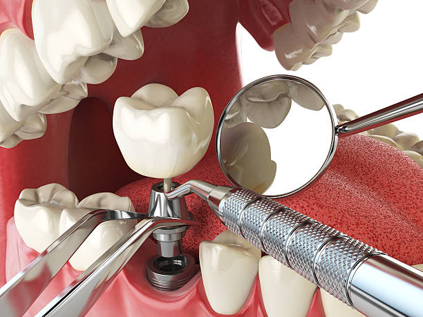 Best Emergency Dental Care for Broken or Chipped Teeth in Toquerville, UT